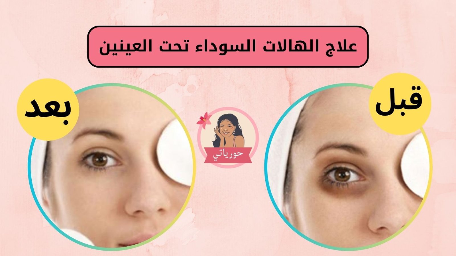 علاج الهالات السوداء تحت العينين