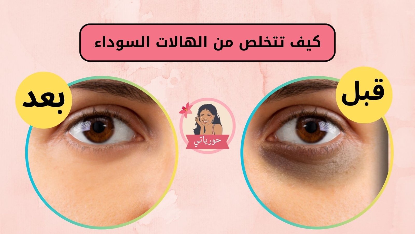 كيف تتخلص من الهالات السوداء