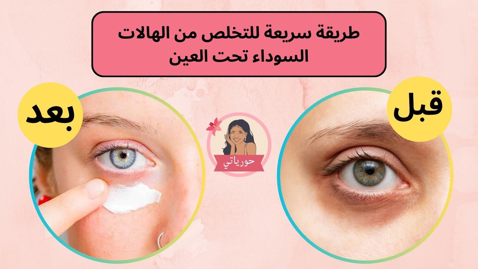 طريقة سريعة للتخلص من الهالات السوداء تحت العين