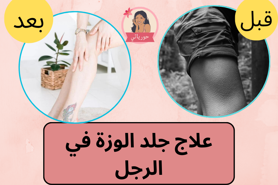 علاج جلد الوزة في الرجل