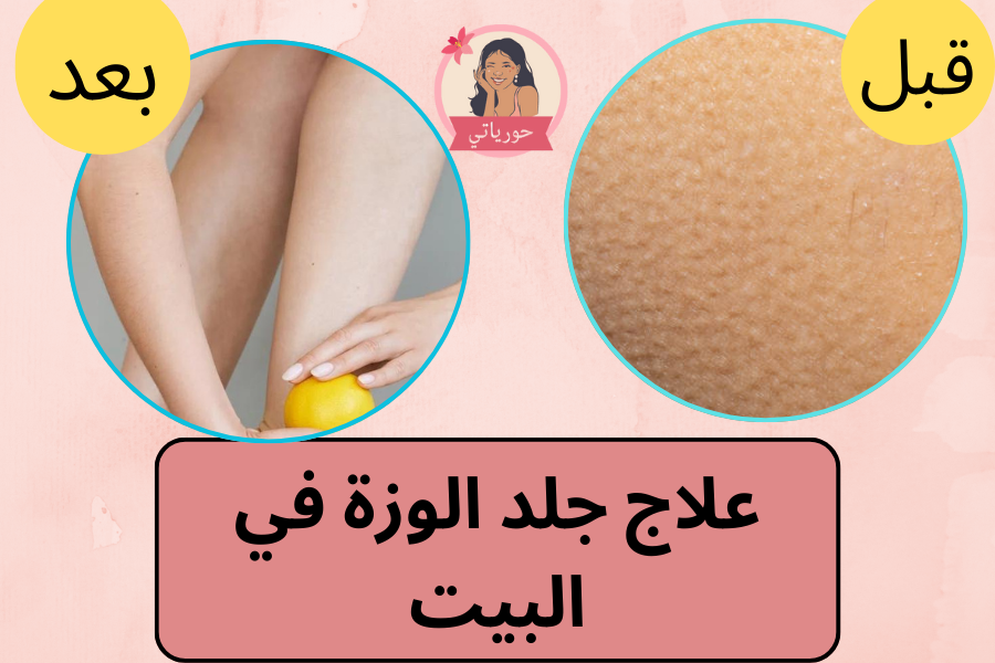 علاج جلد الوزة في البيت