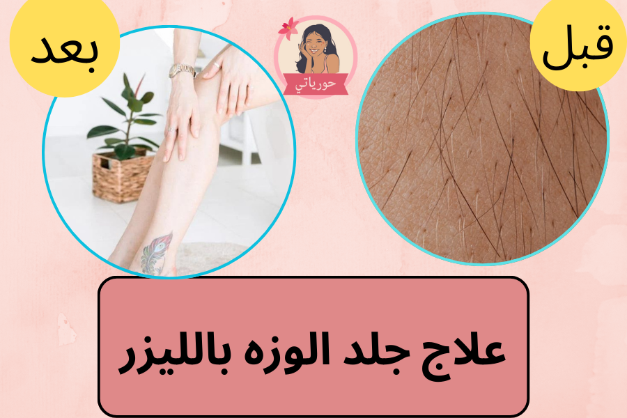 علاج جلد الوزه بالليزر