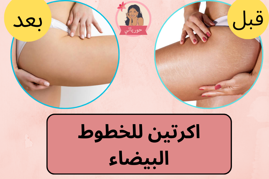 اكرتين للخطوط البيضاء