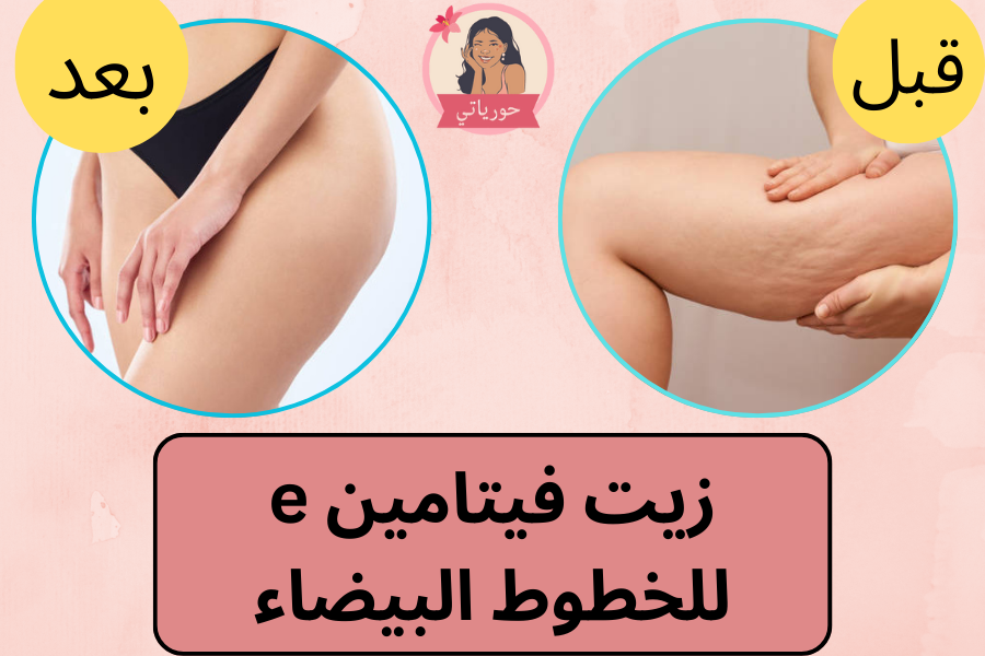 زيت فيتامين e للخطوط البيضاء