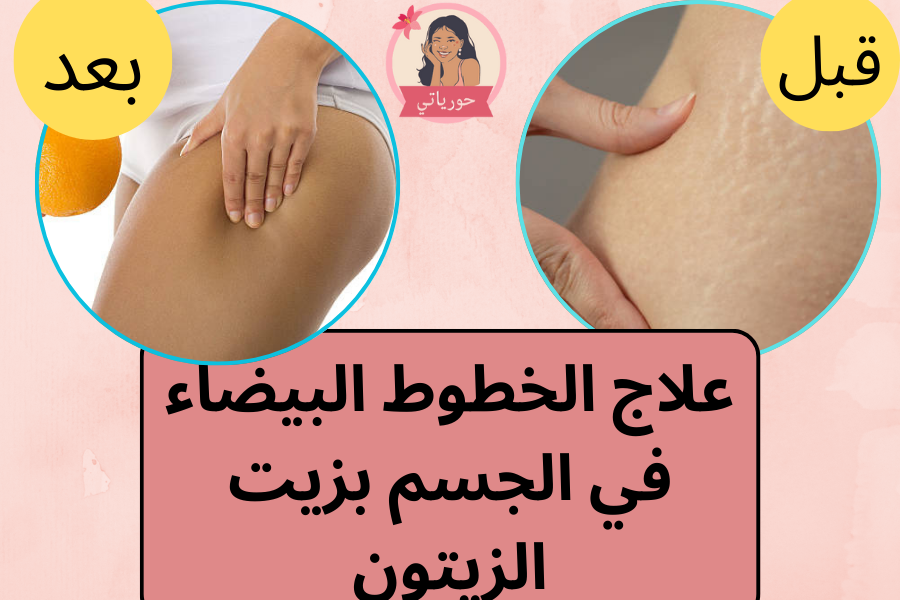 علاج الخطوط البيضاء في الجسم بزيت الزيتون