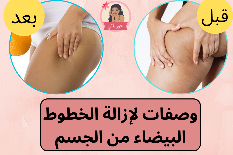 وصفات لإزالة الخطوط البيضاء من الجسم