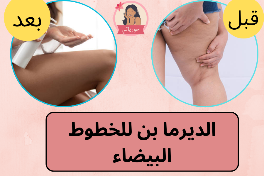 الديرما بن للخطوط البيضاء