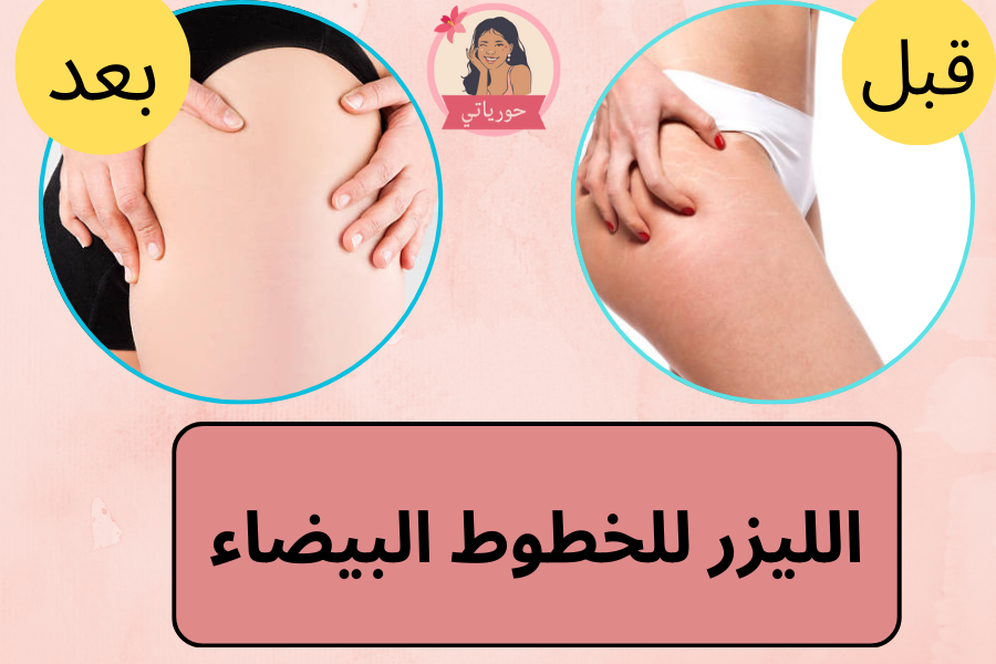 الليزر للخطوط البيضاء