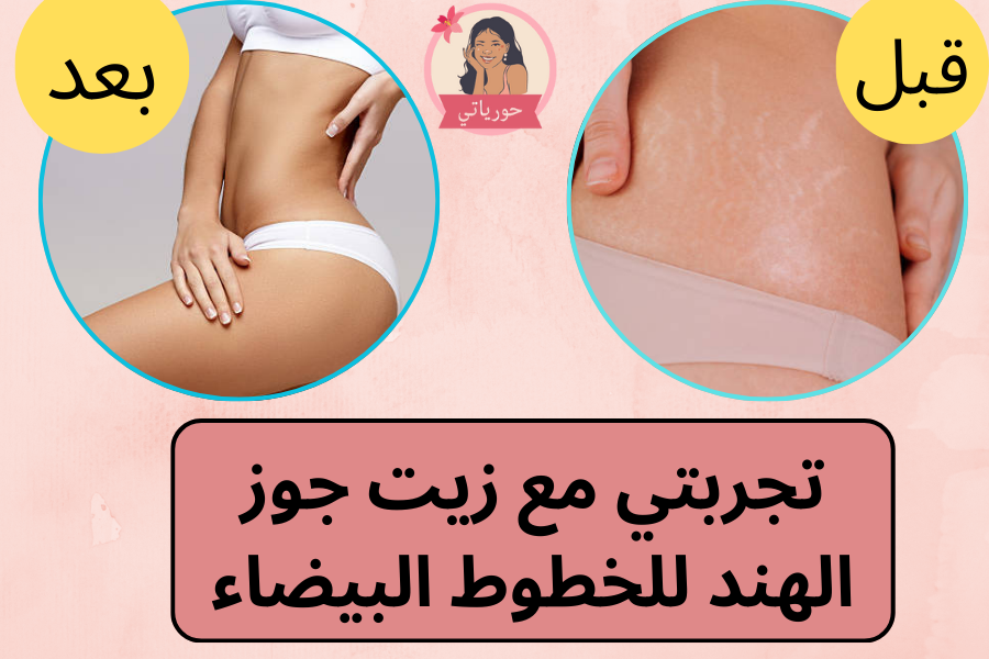 تجربتي مع زيت جوز الهند للخطوط البيضاء