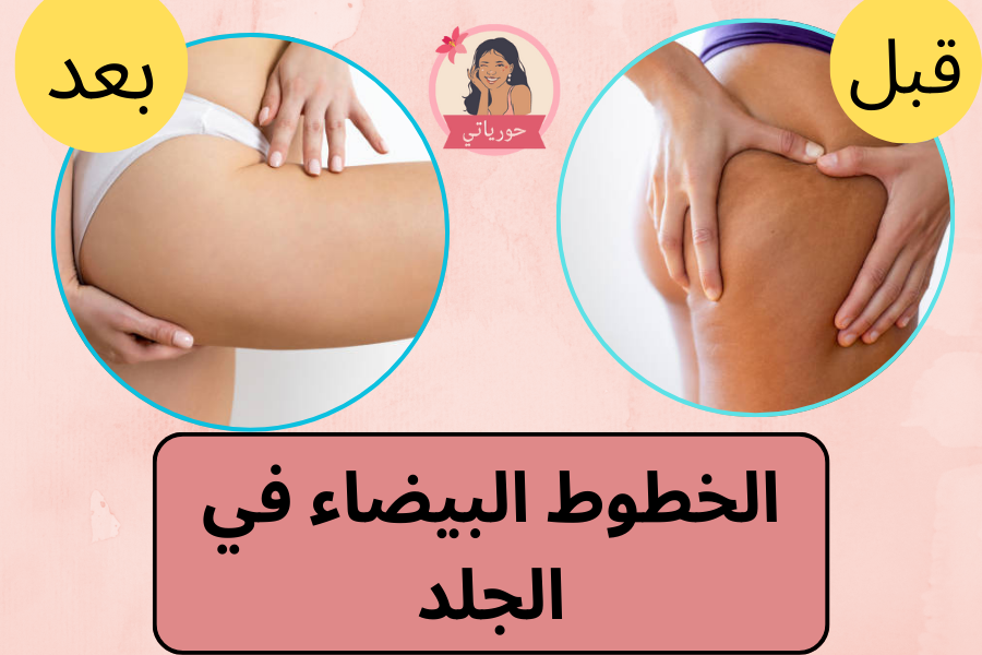 الخطوط البيضاء في الجلد