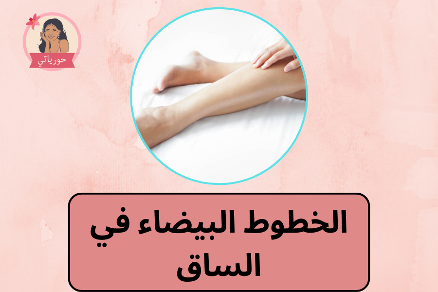 الخطوط البيضاء في الساق