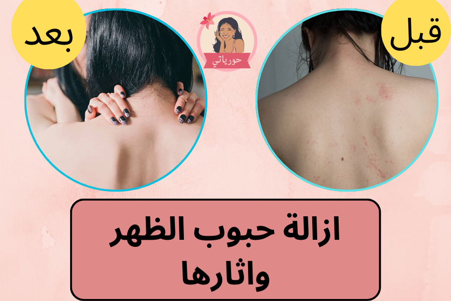 ازالة حبوب الظهر واثارها