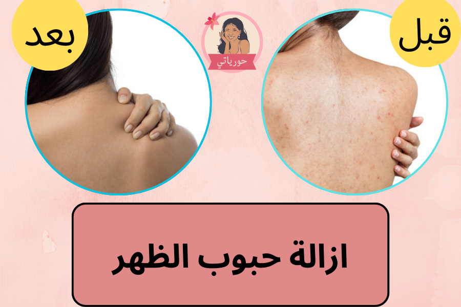 ازالة حبوب الظهر