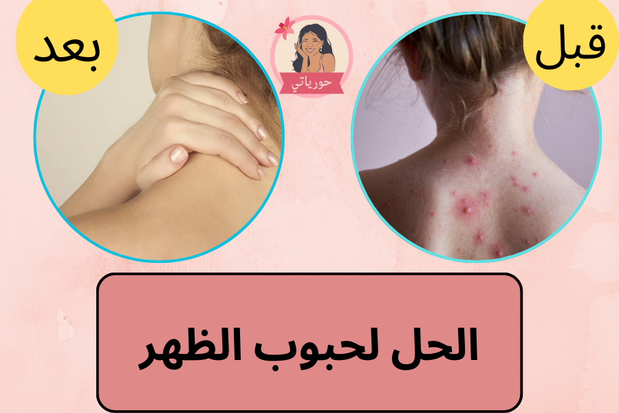 الحل لحبوب الظهر