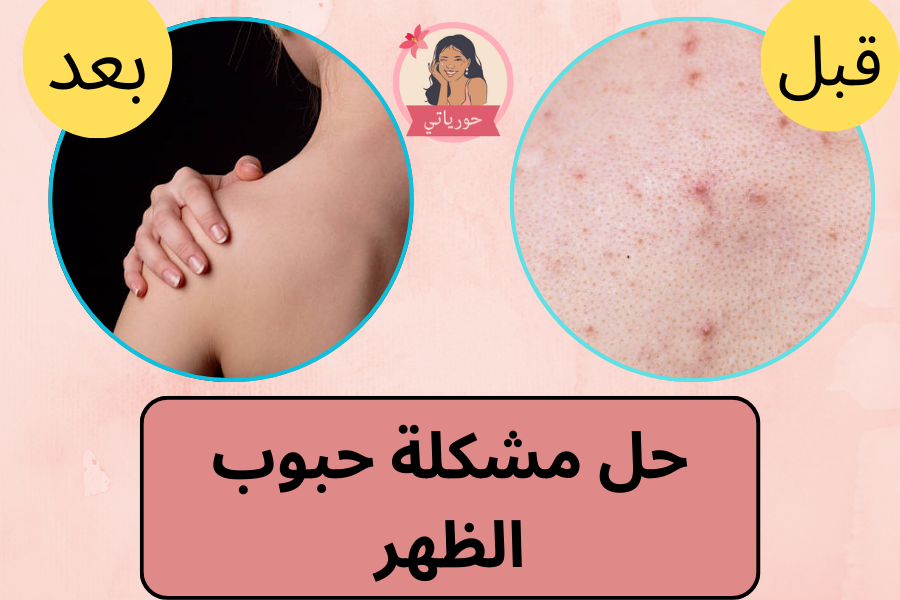 حل مشكلة حبوب الظهر