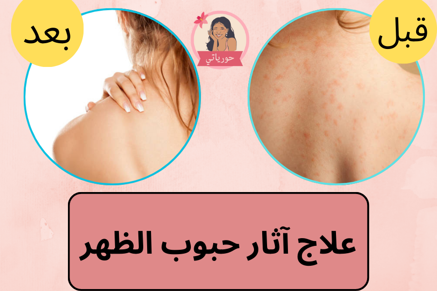 علاج آثار حبوب الظهر