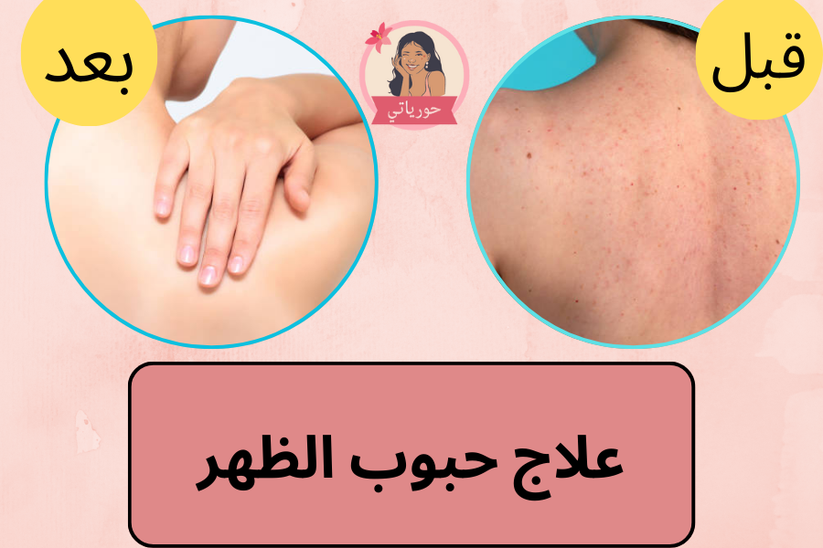 علاج حبوب الظهر