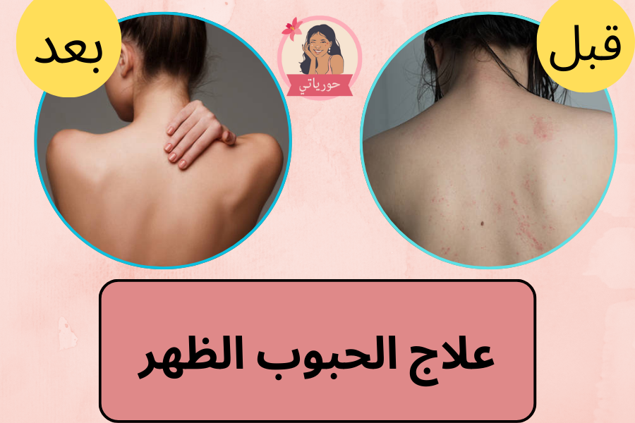 علاج الحبوب الظهر