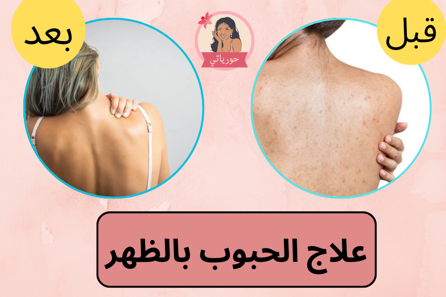 علاج الحبوب بالظهر