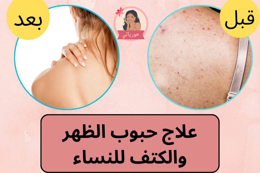 علاج حبوب الظهر والكتف للنساء