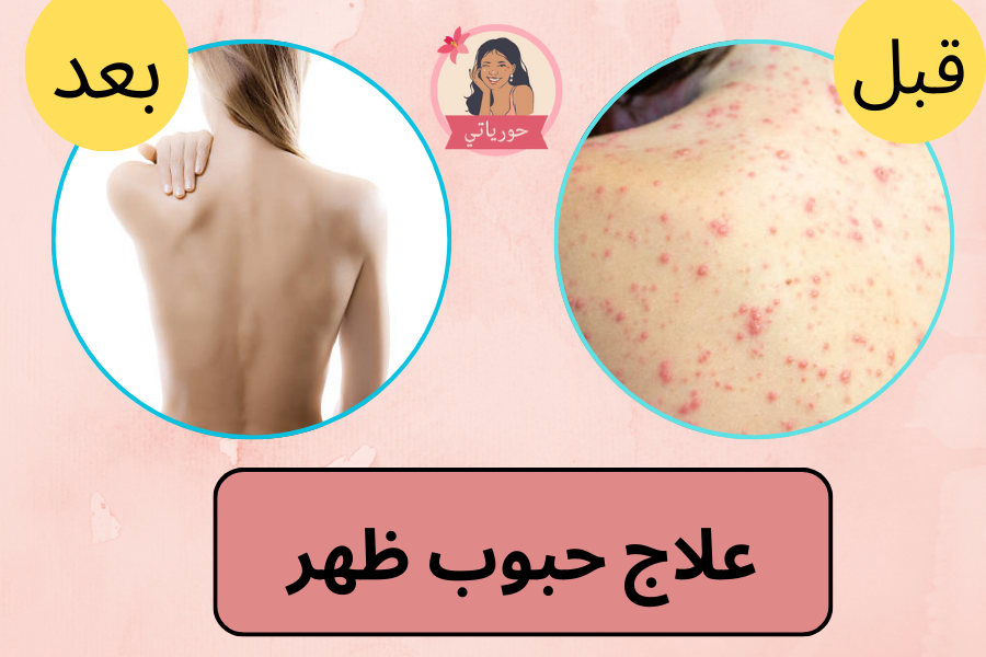 علاج حبوب ظهر