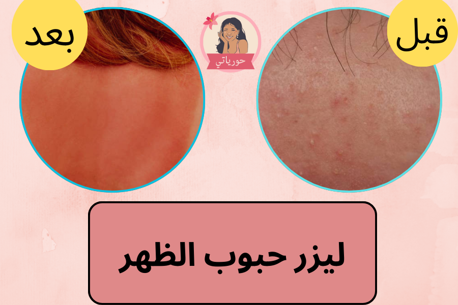 ليزر حبوب الظهر